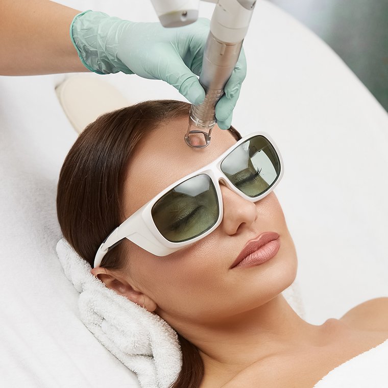 IPL Photofacial